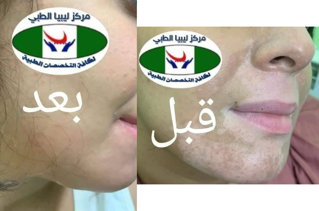 حالات قبل وبعد